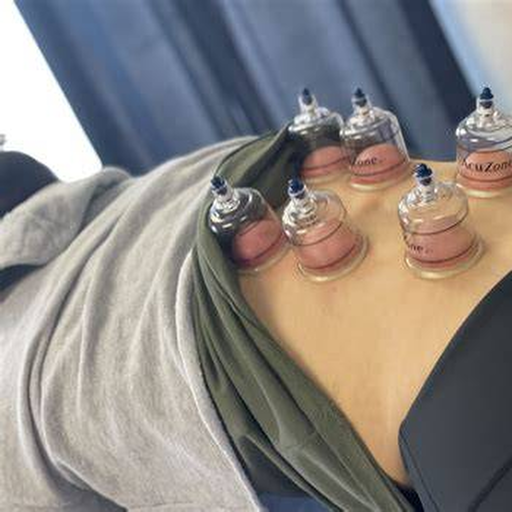 Applicazione di coppette terapeutiche sulla zona lombare