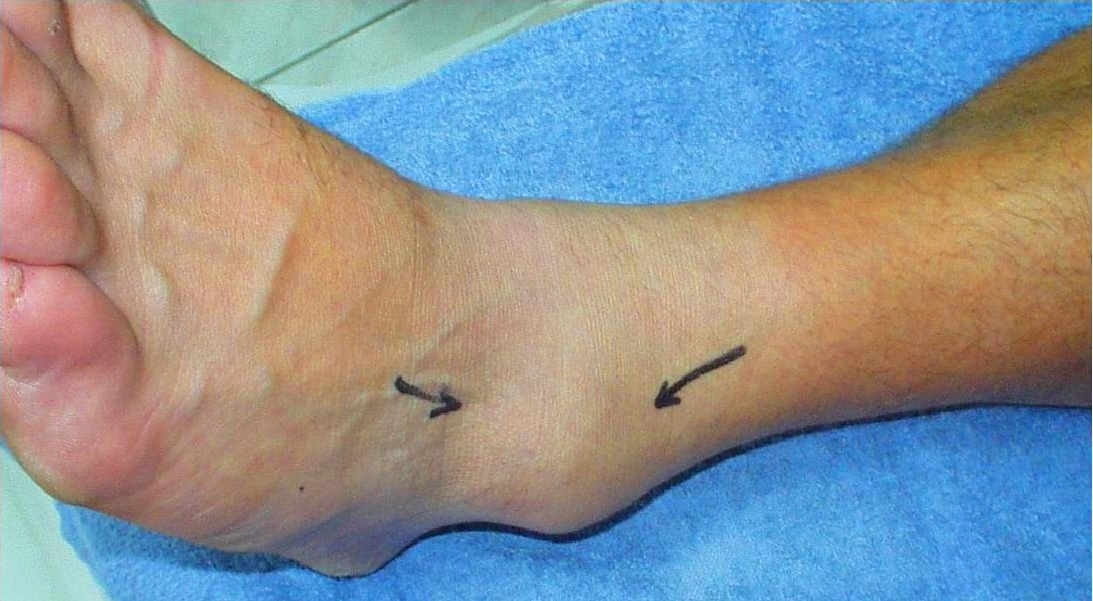 Gonfiore della caviglia dopo una distorsione: immagine clinica illustrativa